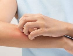 Kenali Ciri-ciri Infeksi Jamur pada Kulit, Gejala dan Cara Mencegahnya