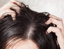 Cara Mudah Menghilangkan Ketombe