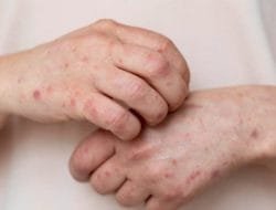 Bio Farma Berencana Impor Tiga Vaksin Cacar Monyet, Ini Daftarnya