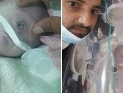 Viral, Lahir Bayi Bermata Satu di Yaman