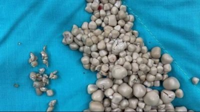 Luar Biasa! Dokter di Taiwan Berhasil Keluarkan 300 Batu Ginjal, Pasien Sehat Kembali