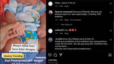 Bayi Lahir dengan 24 Jari di Tangan dan Kaki Viral di Media Sosial