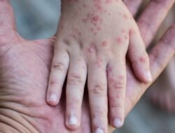 Waspada Campak Saat Lebaran, IDAI Bagikan 6 Tips Lindungi Anak dari Penularan